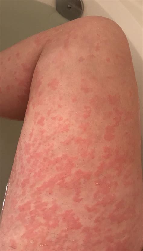 Stress Hives Arms