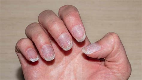 how to take care of nail fungus