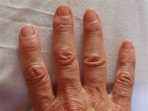 Ehlers Danlos Take Collagen at Emery Espinosa blog