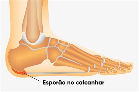 O Que E Bom Para Esporao No Calcanhar - 4 Remédios caseiros para esporão no calcanhar