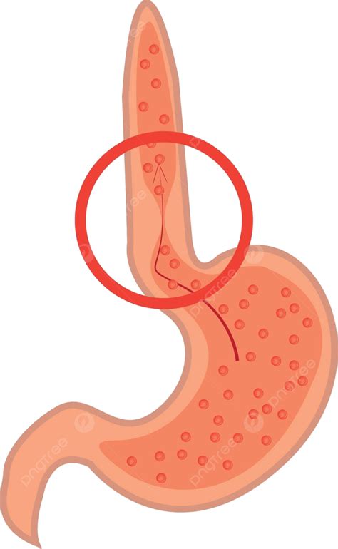 Gastroesophageal Reflux Disease Gerd Stomach Esophagus Internal