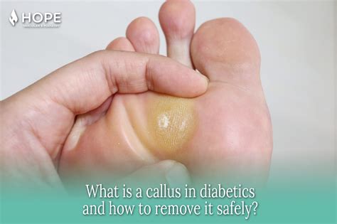 What is a Callus in Diabetics and How to Remove It Safely? - Houston