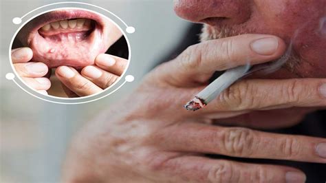 2024 Smoking And Oral Cancer- Risks, Symptoms, Prevention