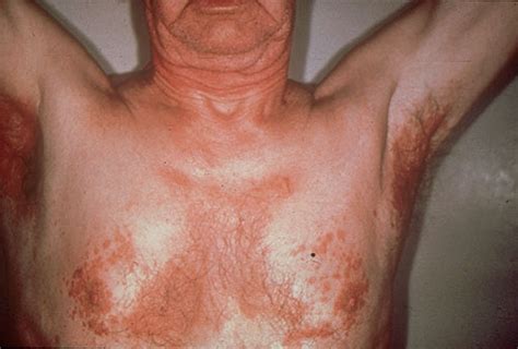 seborrheic dermatitis    nhs  treatments