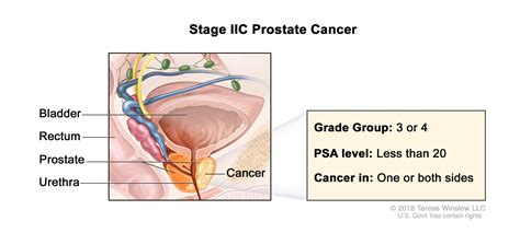 Prostate Cancer Treatment - NCI