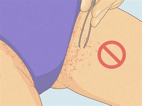 How to Get Rid of Razor Bumps in the Bikini Area: Easy Tips
