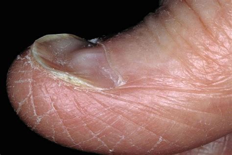 Anemia Nails: How They Look, Causes, and Treatments