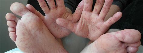 Hand-, voet- en mondziekte – Online Dermatologie
