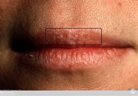 Fordyce Spots On Tongue