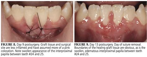 Gingival Graft Alloderm