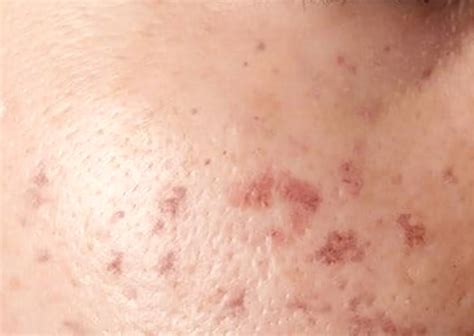 Effective Hyperpigmentation Treatment in KL - Neya Malaysia