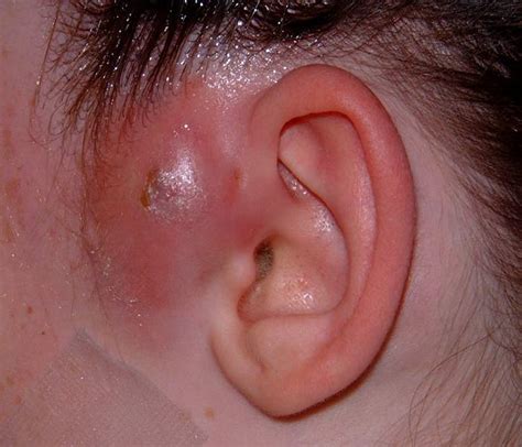 Subcutaneous Abscess Treatment