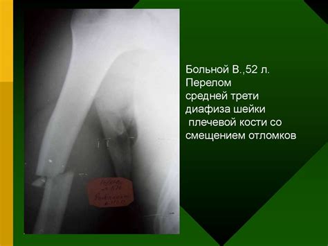 Повреждение плеча, вывихи плеча и предплечья - презентация онлайн