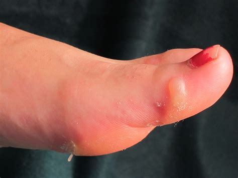 pop blisters   feet ehtn