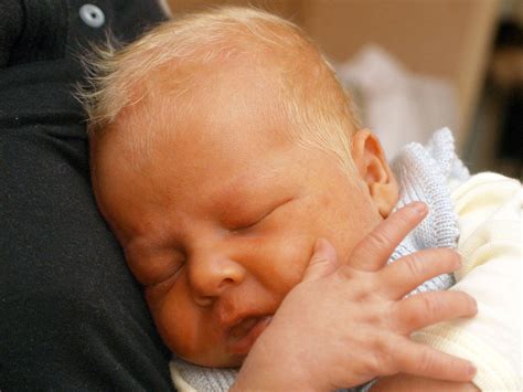 Tiriça Em Bebê - Terçol em bebês: como identificar e tratar | BabyCenter