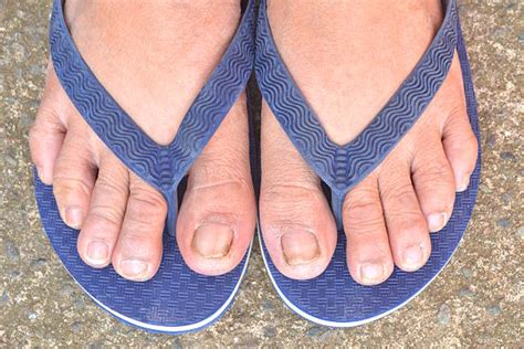 630+ Manchas Blancas En Las Uñas De Los Pies Fotografías de stock ...