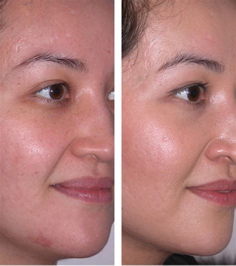 Albums 94+ Pictures Before And After Pictures Of Microdermabrasion Sharp