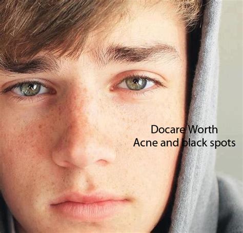 Acne and the black spots