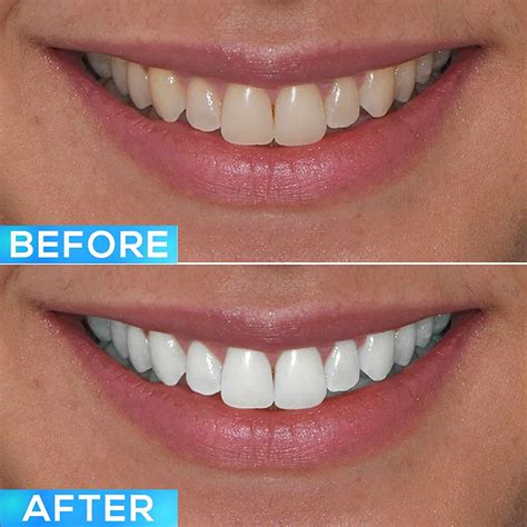 Professional Teeth Whitening - GLO Science