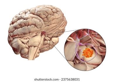 Pituitary Gland Tumor 3d Medical Illustration Stock Illustration 2375638031 | Shutterstock