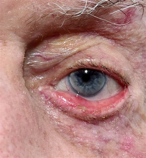 Ectropion: Symptoms, Causes & Treatments