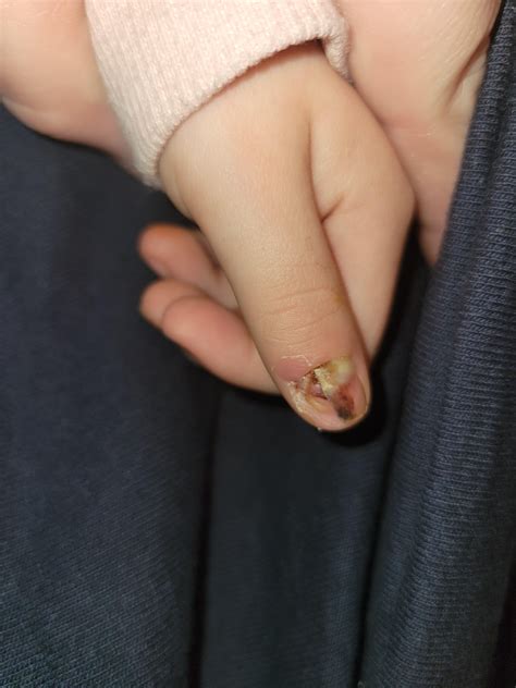 Youngest Daughter slammed finger in car door. : r/MedicalGore