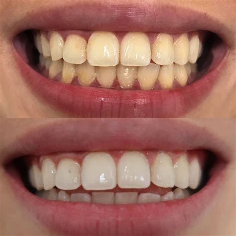how to remineralize teeth 10