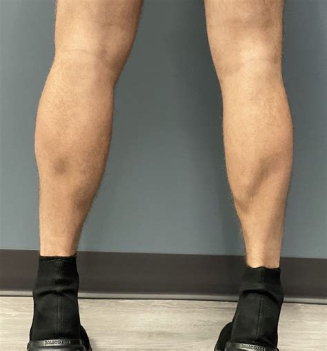 Plastic Surgery Case Study - The Four Calf Implant Approach for