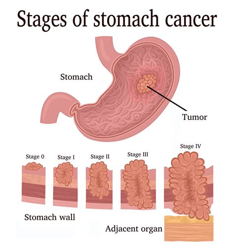 stomach cancer saint johns cancer institute