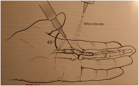 trigger finger shamim umarji hand specialist london