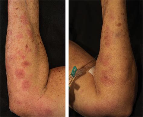 Pancreatic panniculitis following endoscopic retrograde