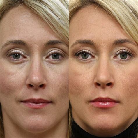 Fio Filler Antes E Depois