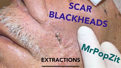 Giant blackheads imbedded in scar tissue extracted. Common occurrence ...