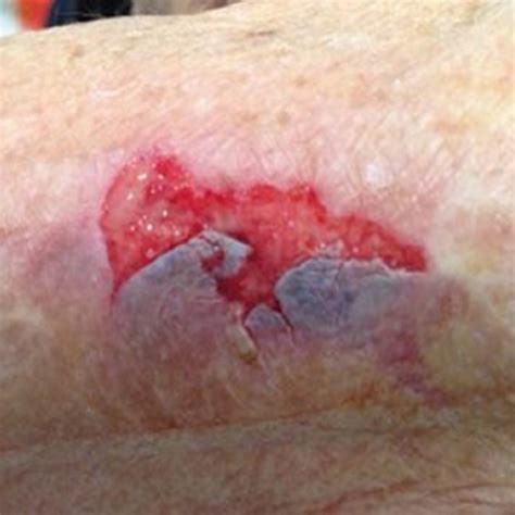 skin tears cynthia rogers md