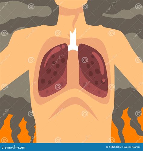 Human Lungs, People Suffering from Industrial Smog, Respiratory Disease