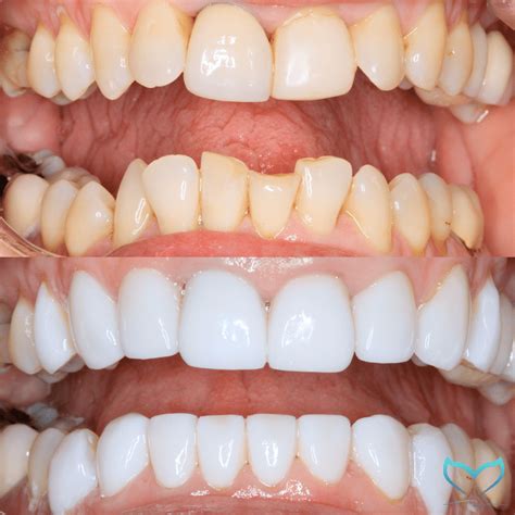 Veneers vs. Teeth Whitening: Which Is Right for You? - Dentist Gold ...