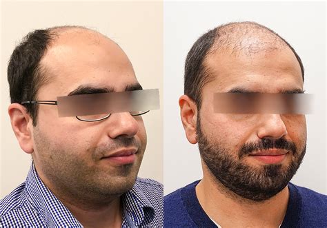 FUE Hair Transplant Before & After Gallery | Hair Transplant Toronto Clinic