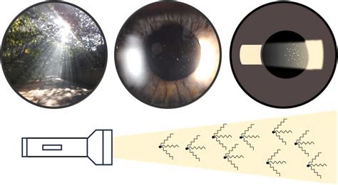 anterior chamber inflammation grading methods  critical review