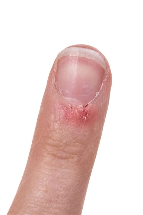 Premium Photo | Flaky skin on the finger