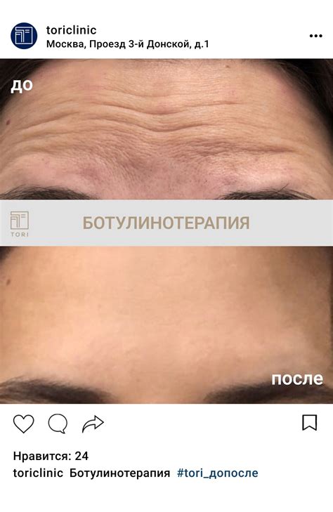 Ботулинотерапия лица и тела: цена в Москве