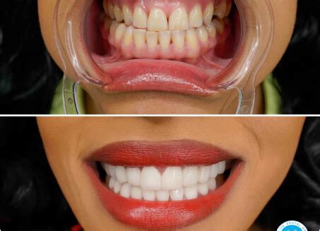 DENTAL PACKAGES