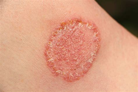 Common Fungal Skin Infections