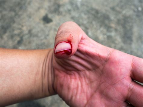 How to Treat Annoying & Painful Finger Cuts - We Can Be Aeros