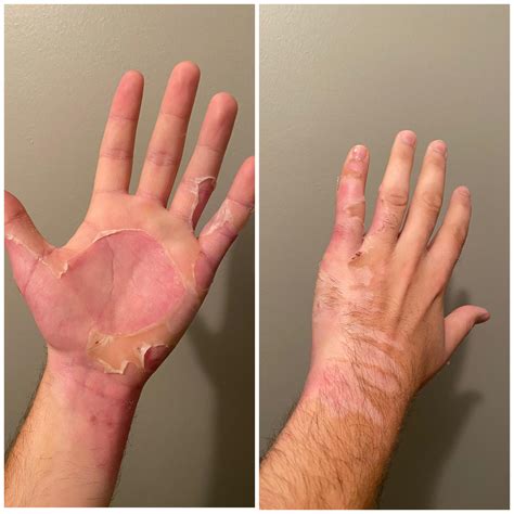 Flaking skin from a 2nd degree burn : r/peeling