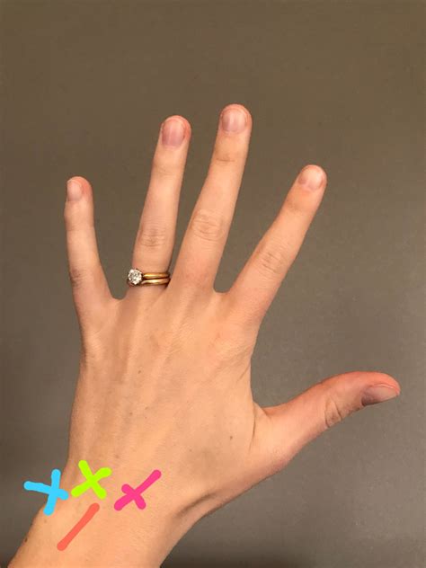 Ulnar Wrist Pain Causes