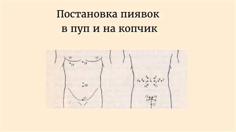Постановка пиявок в пуп и на копчик - YouTube