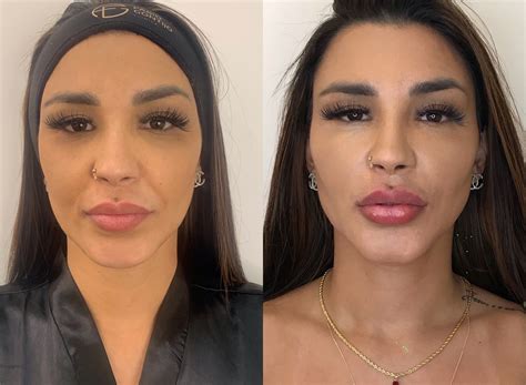 Cirurgia Plástica Rosto Antes E Depois - Jenna Marmores Plastica No Nariz Antes E Depois Antes E Depois: Veja