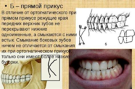 Прямой прикус у человека: что это такое, такой ли он правильный, фото ...