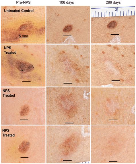 Pigmented seborrheic keratoses from a single subject shown before ...