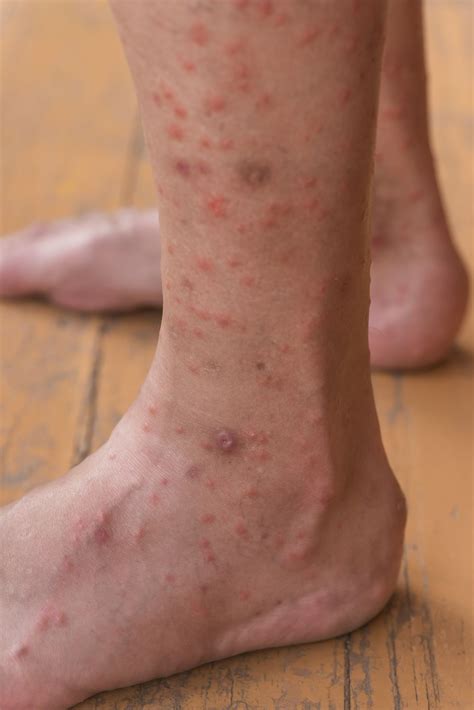 Mosquito Bites Pictures Allergic Reaction